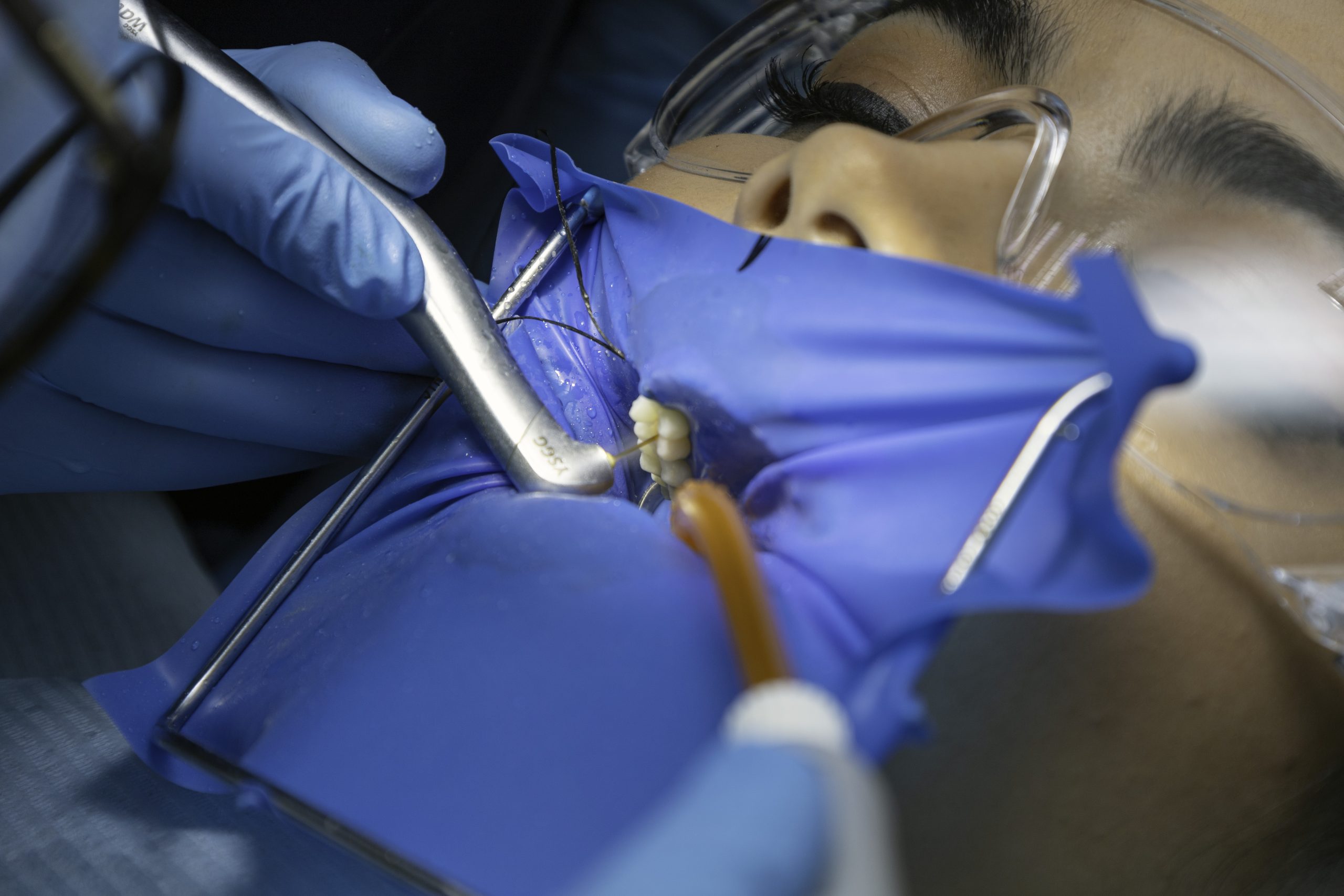 Cum-poate-tratamentul-cu-laser-sa-vindece-cariile-fara-durere-scaled