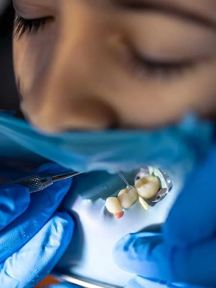 Restaurări dentare-home