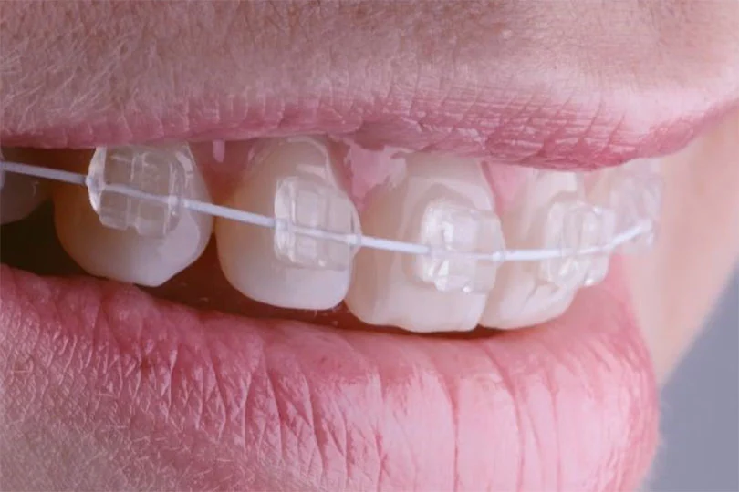 aparat_dentar_safir_wide